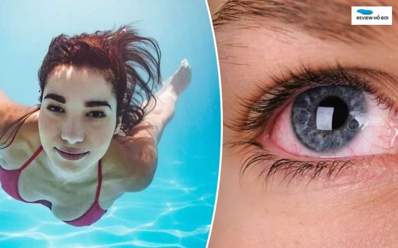 Đau mắt đỏ khi đi bơi: Nguyên nhân và cách xử lý hiệu quả Nước bị nhiễm khuẩn là nguyên nhân chính đau mắt đỏ khi đi bơi