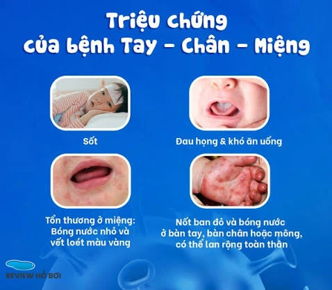 CẢNH BÁO ĐỎ: NGUY CƠ BÙNG PHÁT DỊCH BỆNH TẠI CÁC HỒ BƠI CÔNG CỘNG – BẢO VỆ SỨC KHỎE GIA ĐÌNH BẠN NGAY HÔM NAY Bệnh Tay - Chân - Miệng ở trẻ nhỏ Nguồn: medinet